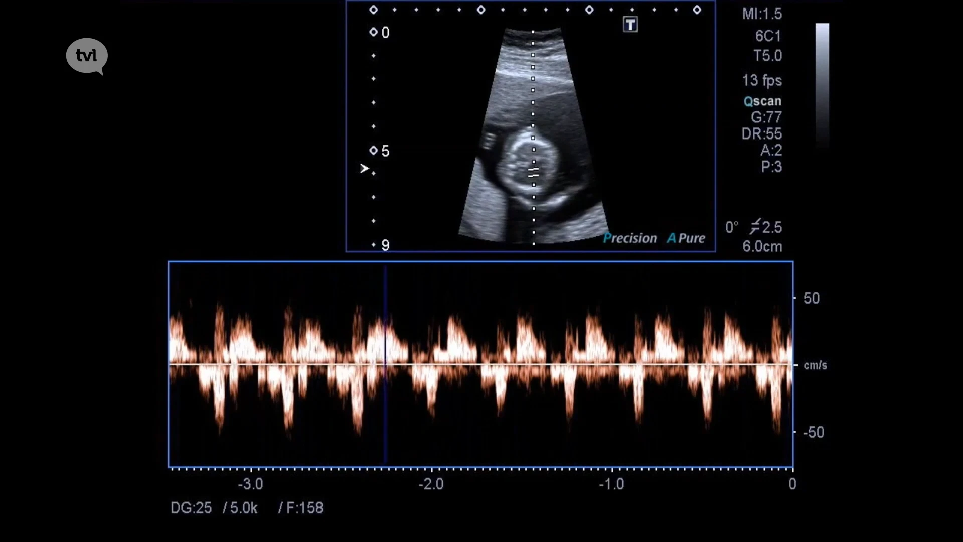 Abortuscentra LUNA vzw vragen nieuwe abortuswet wegens groot aantal aanvragen