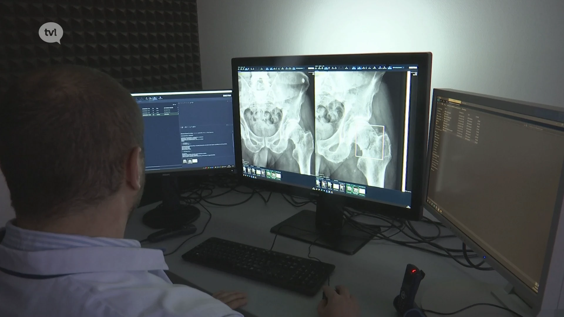 Heusdens Sint-Franciscusziekenhuis versnelt analyse van breuken via artificiële intelligentie