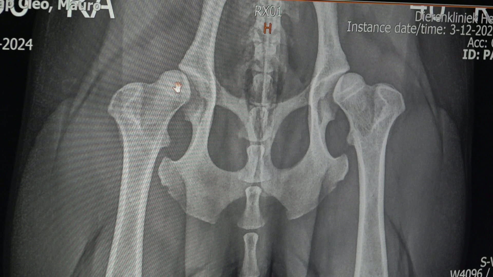 Hoofdafbeelding voor artikel 3D-geprinte heupoperatie in…