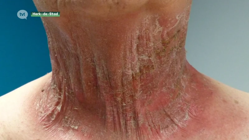 Limburgs bedrijf ontwikkelt verzorgingsproducten tegen huid- en haarproblemen bij kankerpatiënten